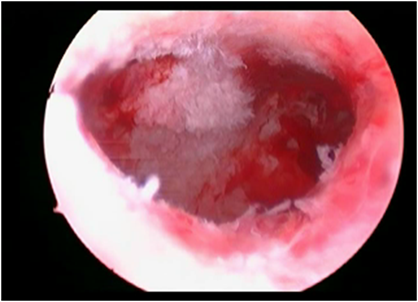 ashermanafteroperation