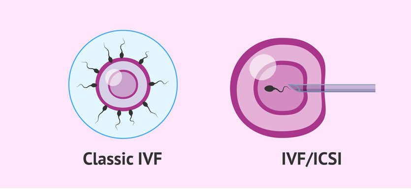 ivf & icsi treatments