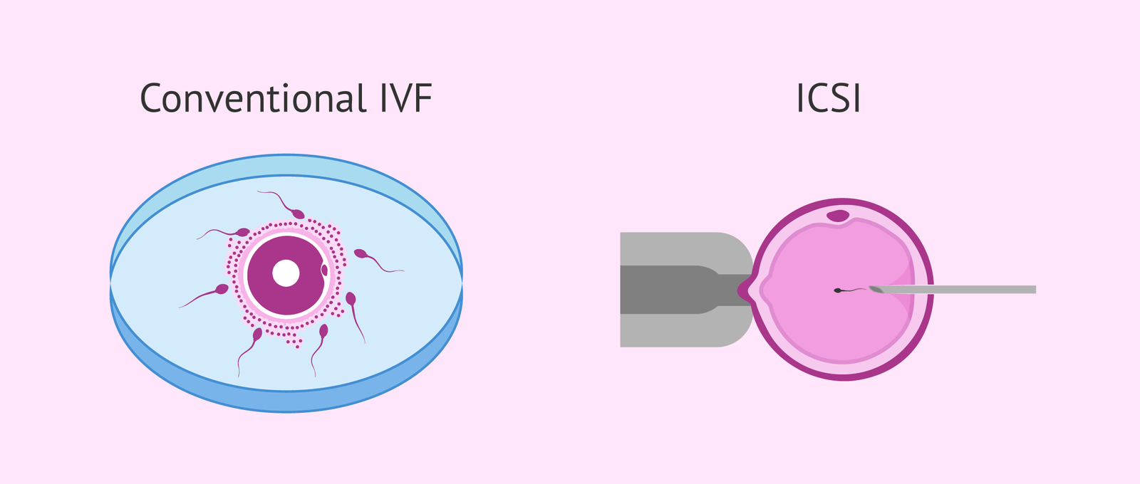 new ivf in vitro fertilization