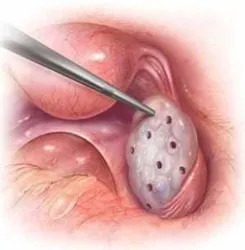 pcos treatment & ovary drilling