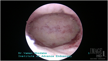 septate uterusafteroperation